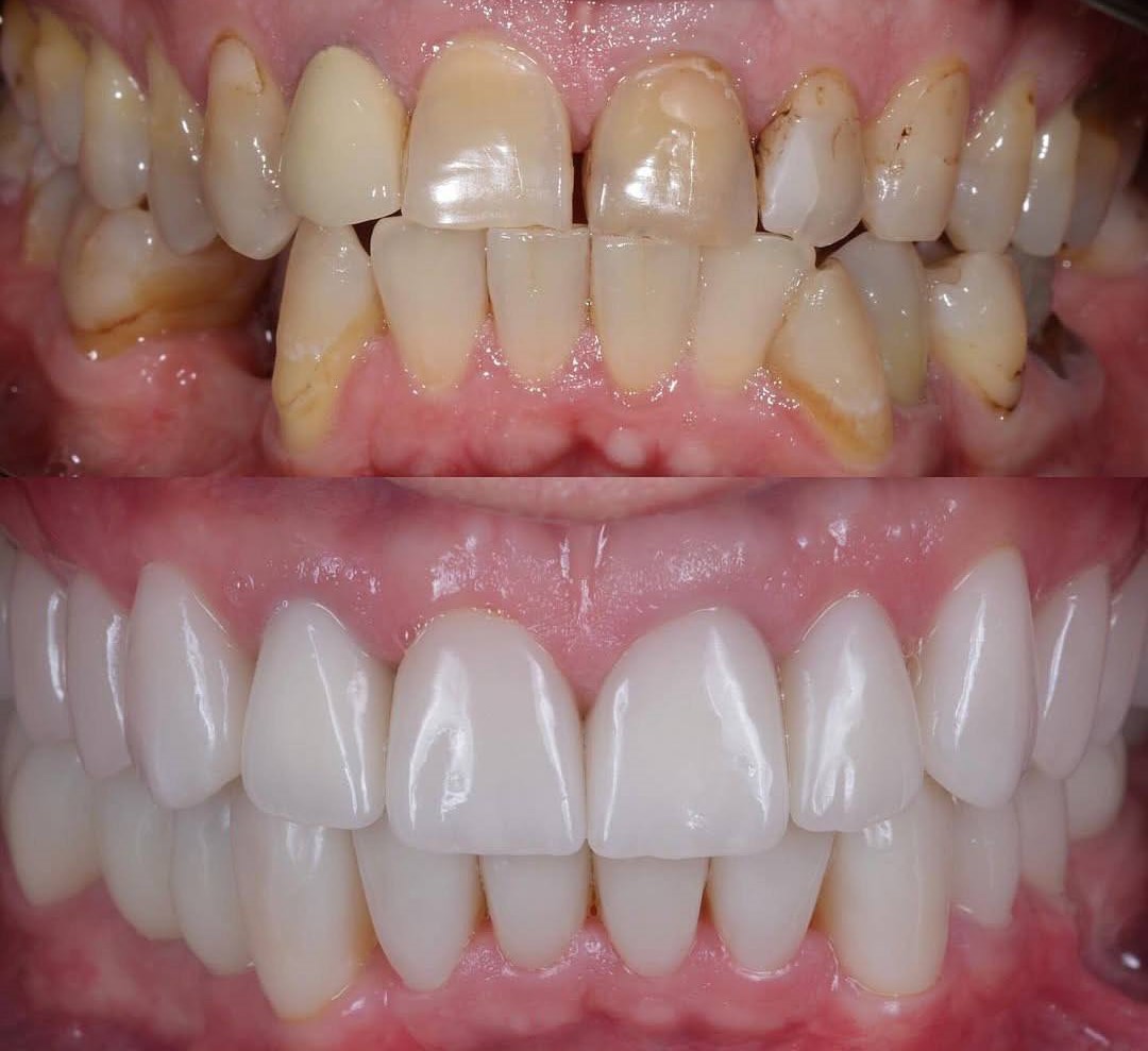 Протезирование зубного ряда